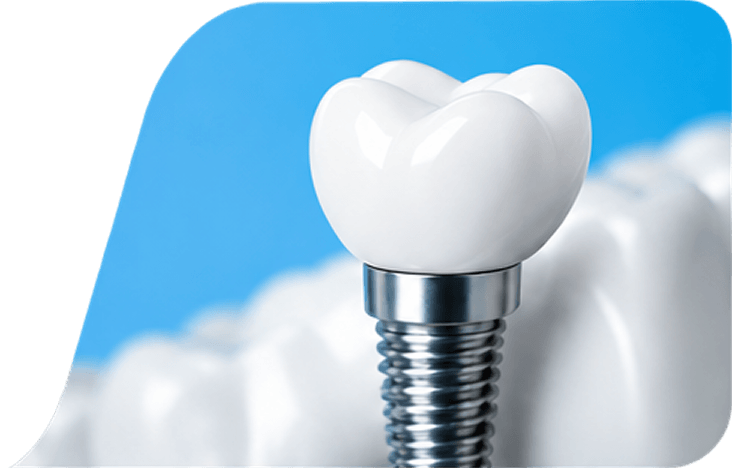 A ceramic crown fitted on a dental implant in a model jaw