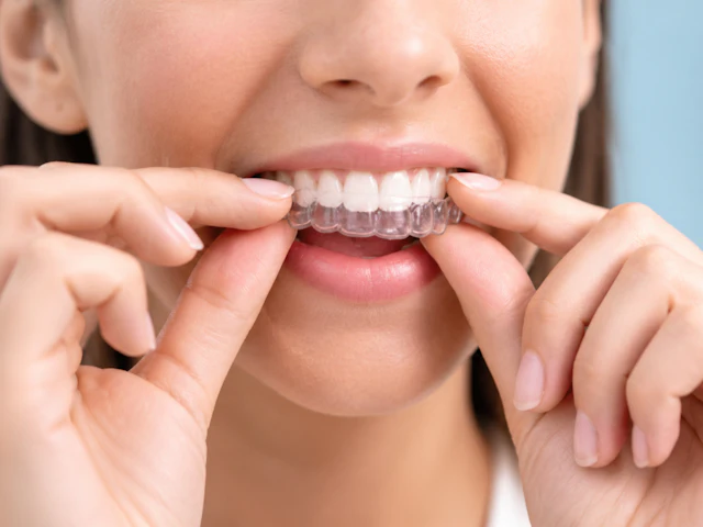 A person fitting a clear aligner over their teeth