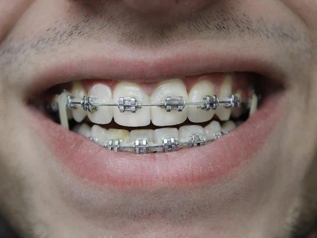 A close-up smile with orthodontic braces